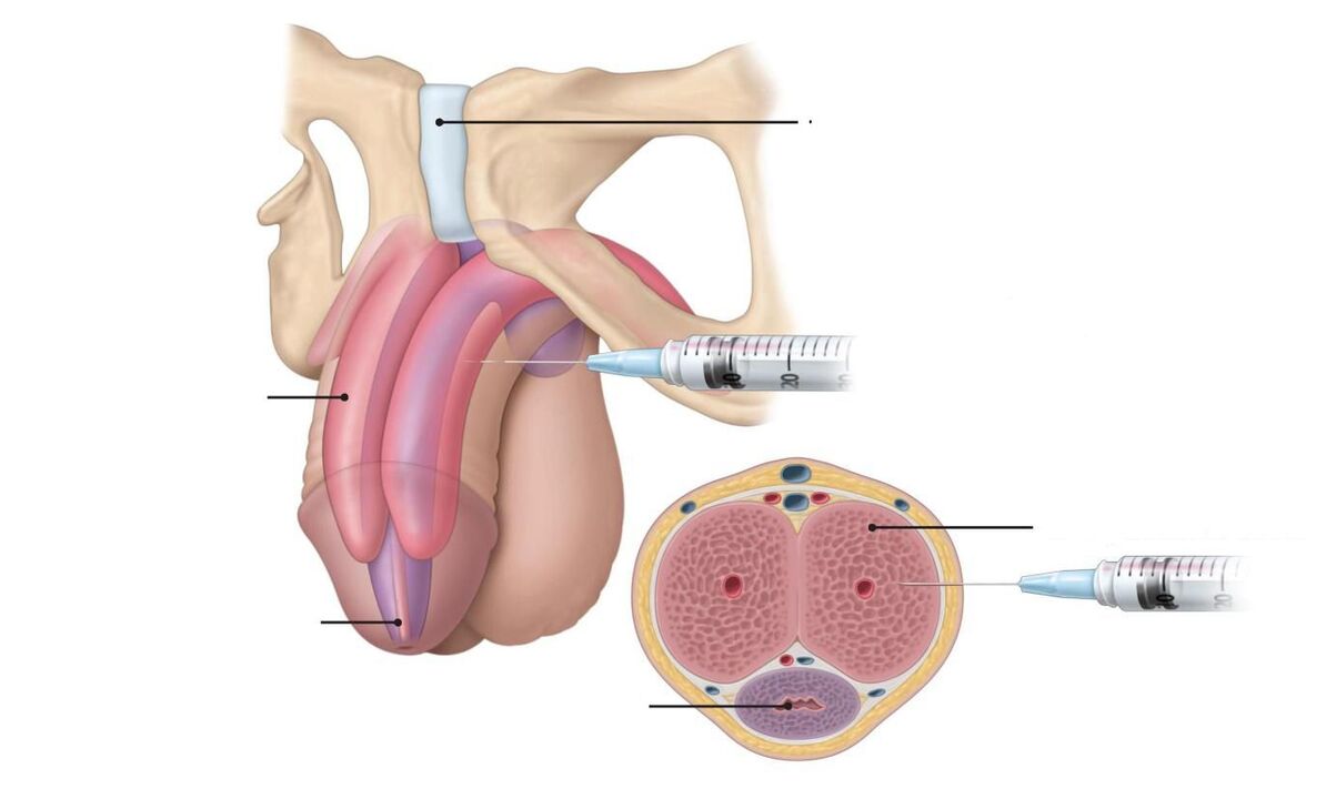 injections pikeun ngaronjatkeun potency